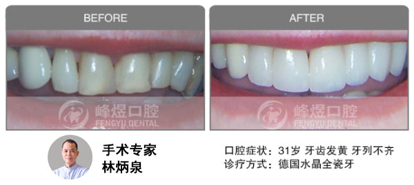 德国水晶全瓷牙修复牙齿发黄、牙列不齐前后效果图对比图片