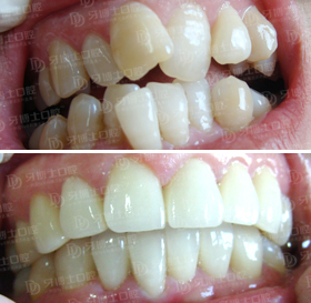 牙齿畸形前后对比
