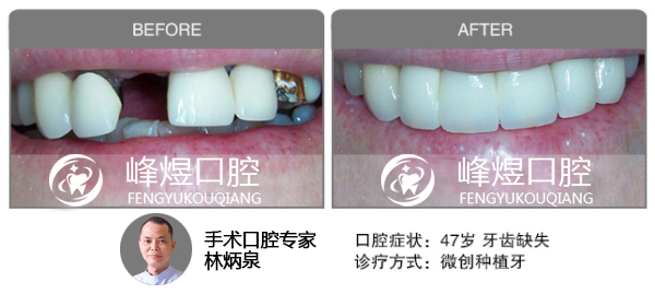 微创种植牙修复牙齿缺失前后效果图对比图片