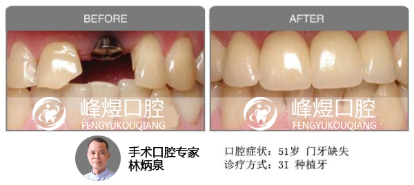 德国费亚丹种植牙修复门牙缺失前后效果图对比图片