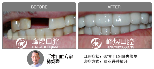 费亚丹种植牙修复门牙缺失前后效果图对比图片