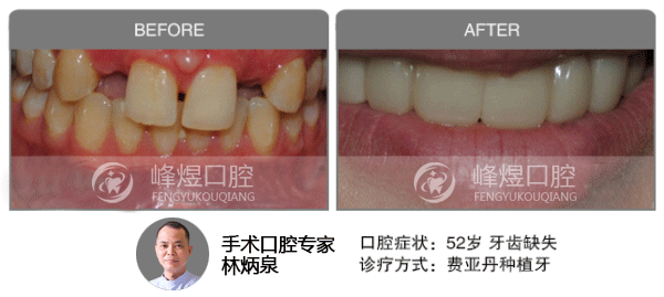 费亚丹种植牙修复牙齿缺失前后效果图对比图片